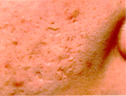 �A�N�l�N���[�^�[