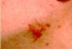 �A�N�l�P���C�h